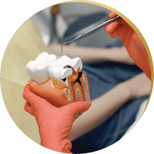Detailed model of a tooth with decay – A demonstration of tooth anatomy, emphasizing the role of dental implants in restoration.