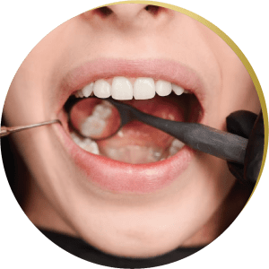 A close-up of a smiling patient undergoing a dental examination for wisdom teeth removal with a dental mirror and scaler, illustrating the importance of preventive dental care