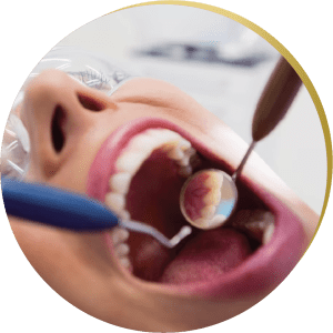 Close-up of a dental check-up with tools inside a patient’s mouth – A dentist examining teeth for potential inlays & onlays treatment.