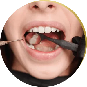 A close-up of a patient’s teeth being prepped for porcelain veneers application.