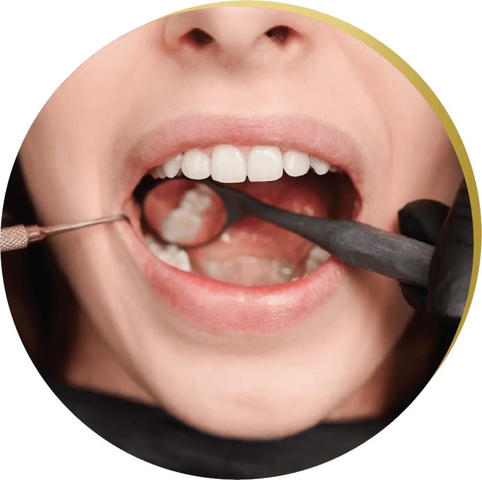 A close-up of a patient’s teeth being prepped for porcelain veneers application.