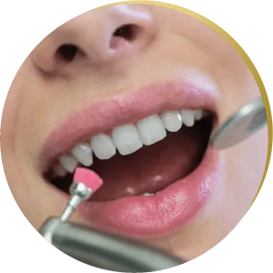 Close-up of a patient receiving a polishing treatment after tooth-colored fillings, with dental tools in use