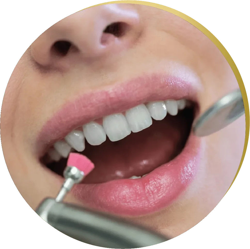 Close-up of a patient receiving a polishing treatment after tooth-colored fillings, with dental tools in use
