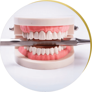 Model of a full dental arch demonstrating All on 4 Dental Implants, showing the structure and function of implant-supported teeth.
