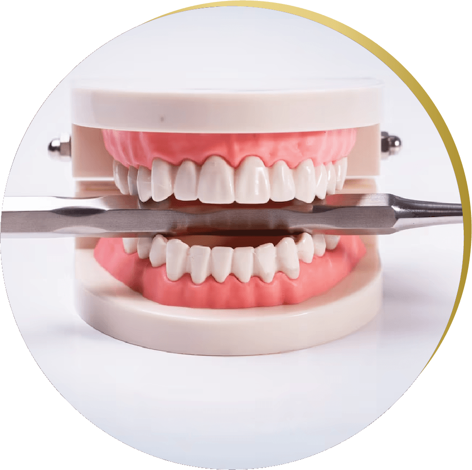 Model of a full dental arch demonstrating All on 4 Dental Implants, showing the structure and function of implant-supported teeth.