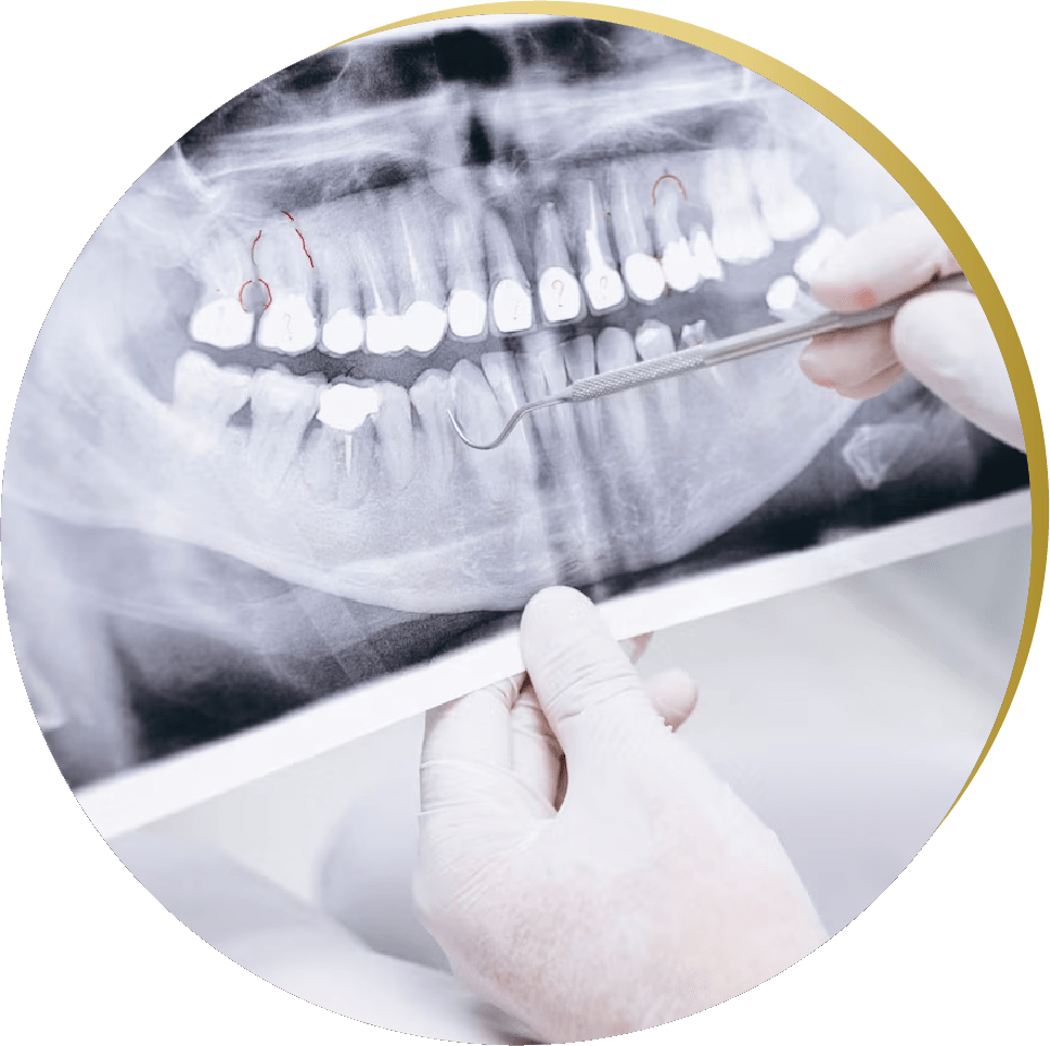 Dental X-ray analysis, highlighting areas for potential All on 4 Dental Implants, with a dentist pointing at critical points.