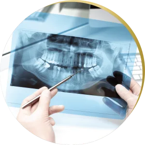 Dental X-ray analysis, highlighting areas for potential All on 4 Dental Implants, with a dentist pointing at critical points.