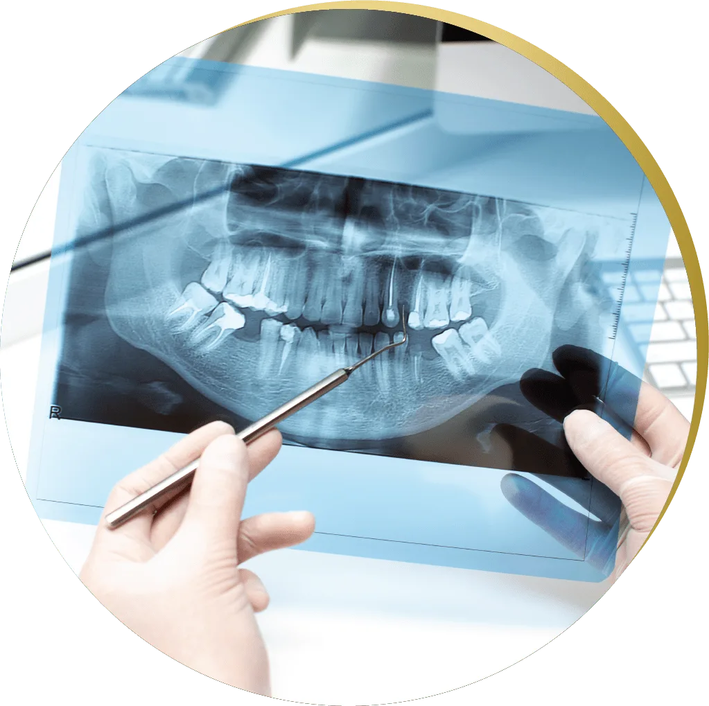 Dental X-ray analysis, highlighting areas for potential All on 4 Dental Implants, with a dentist pointing at critical points.